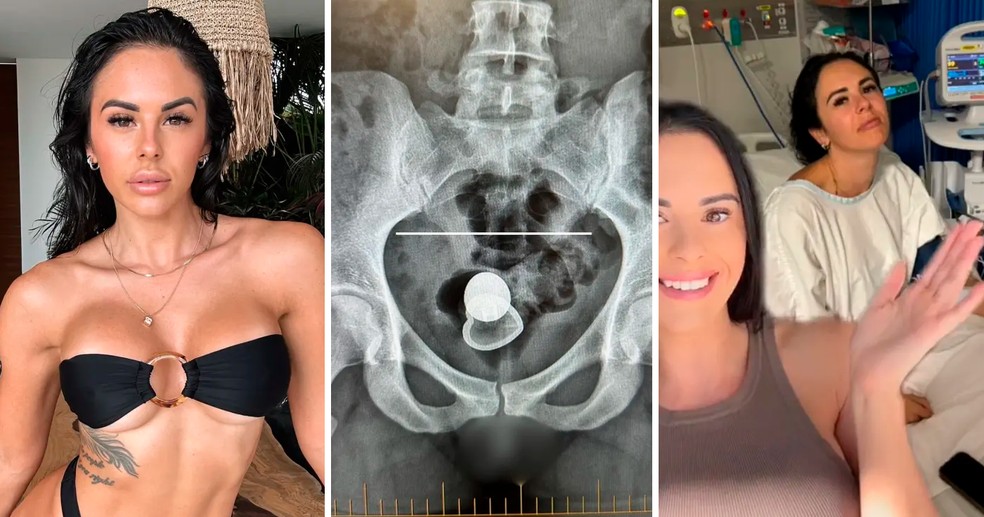 OnlyFans star Hospitalized after first date X-ray showed missing butt plug was deep inside her